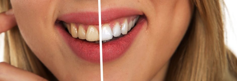 Balti ir sveiki dantys: svarbiausios priežiūros taisyklės