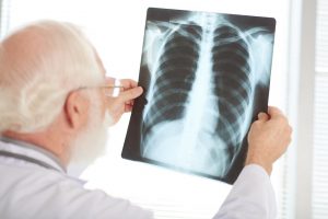 Plinta nauja ir mirtinai pavojinga tuberkuliozės forma: ligonis nejaučia jokių simptomų