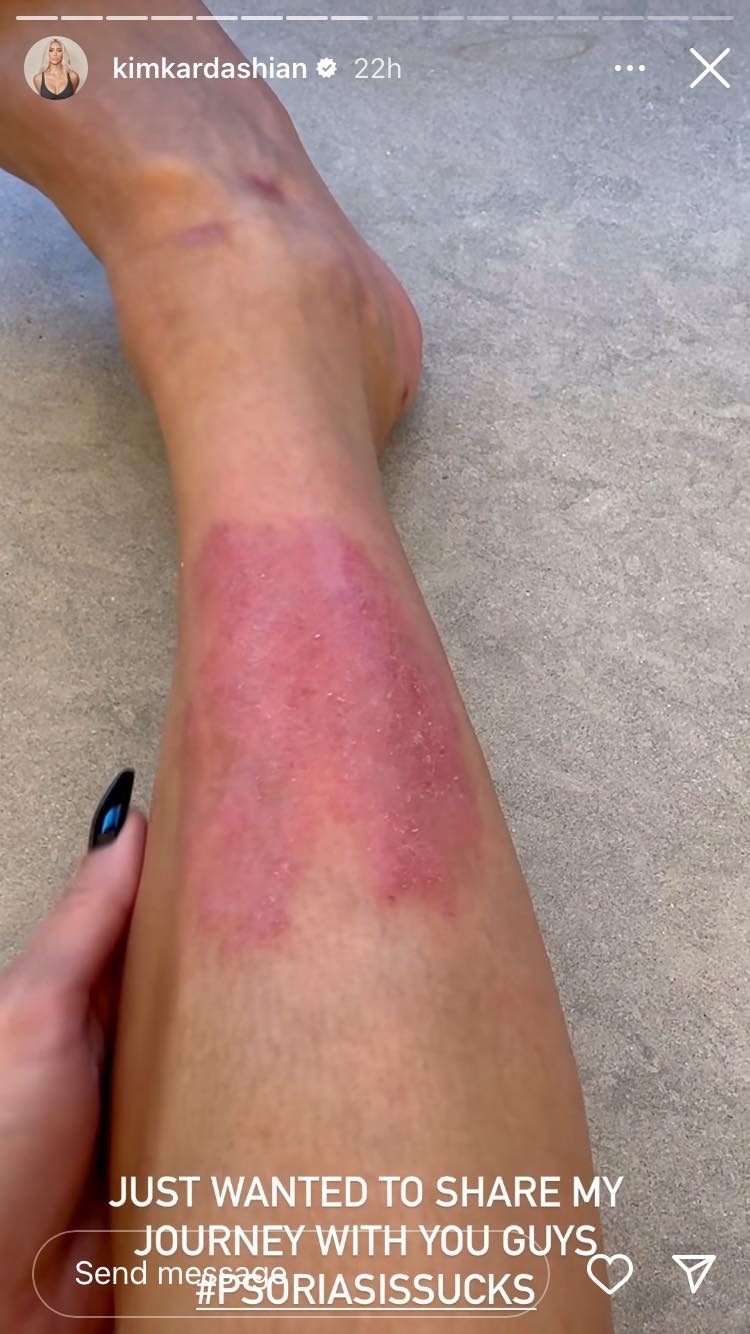 K. Kardashian parodė žaizdotą koją: nepagydoma liga progresuoja