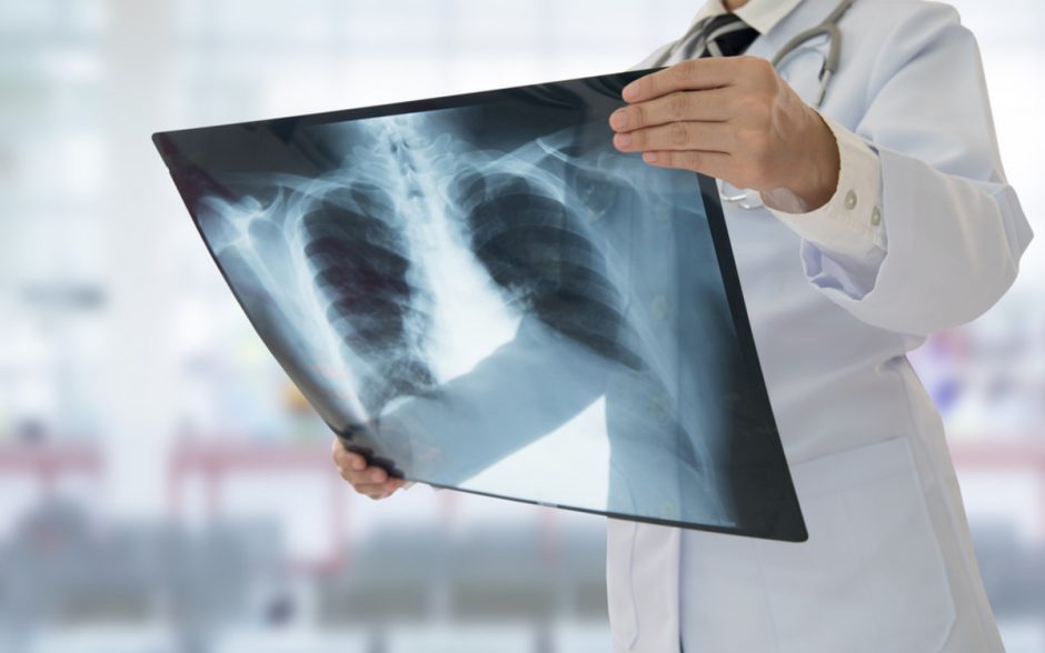 Kauno apskrityje daugėja pneumokokinės infekcijos atvejų 