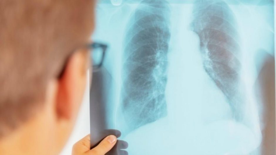Pernai išaiškinta 30 tuberkulioze susirgusių vaikų