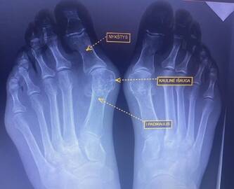 Hallux valgus: šioje rentgeno nuotraukoje matyti, kaip atrodo deformuotas pėdos kauliukas.