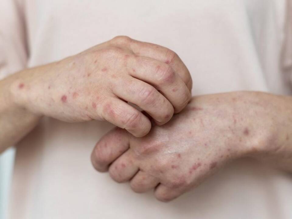 Vengrijoje ir Norvegijoje nustatyti pirmieji užsikrėtimo beždžionių raupais atvejai