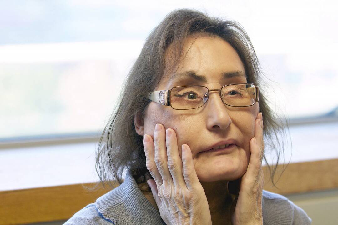 Mirė pacientė, kuriai pirmajai JAV buvo persodintas veidas