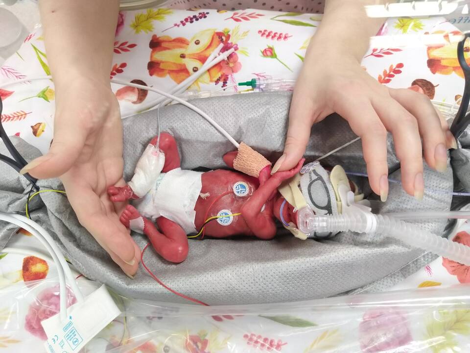 Jausmai: išgelbėtą vos 514 g svėrusios dukros gyvybę tėvai vadina stebuklu.