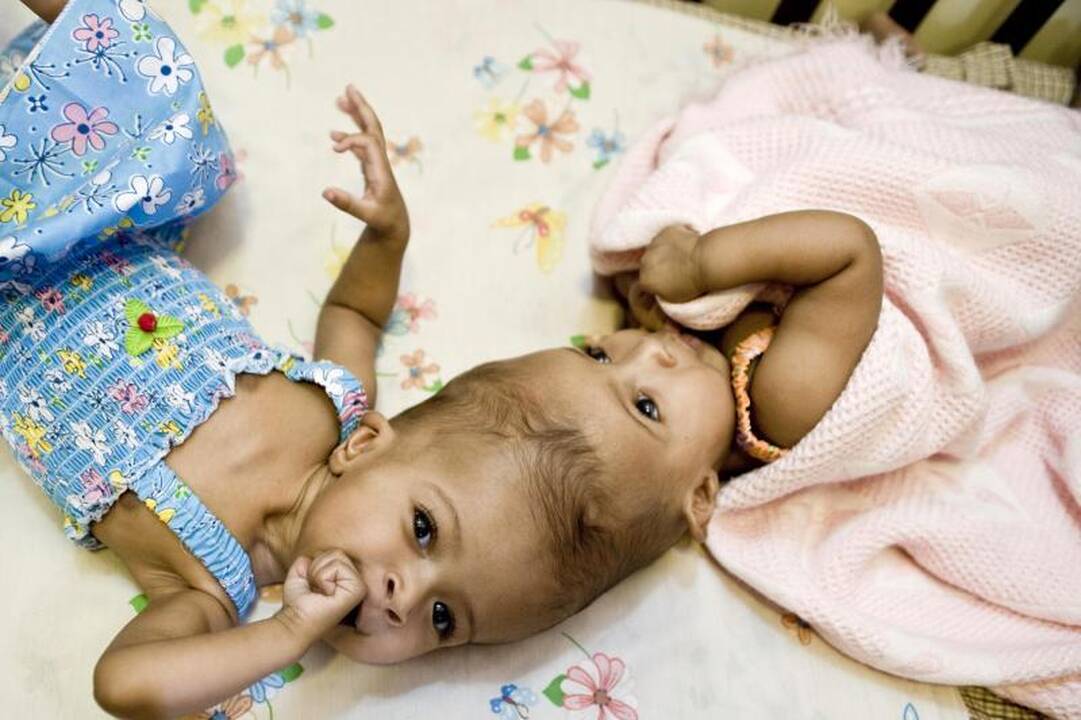 Medikai: britų chirurgų atskirtos Siamo dvynės jaučiasi gerai