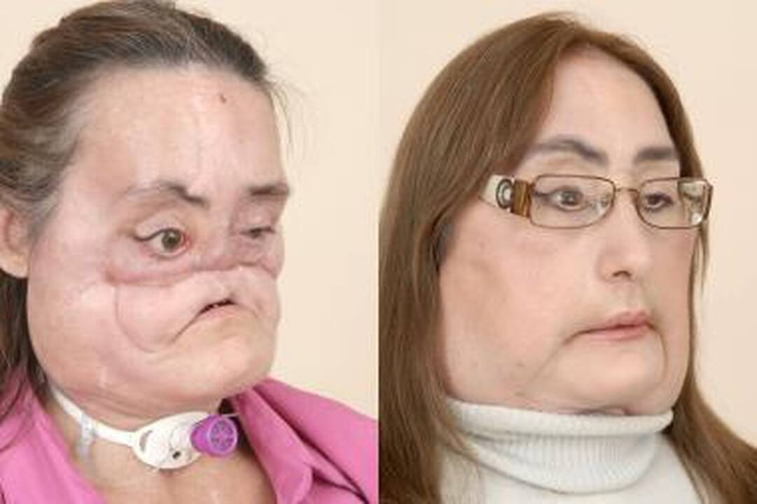 Moteris gyvens su nauju veidu