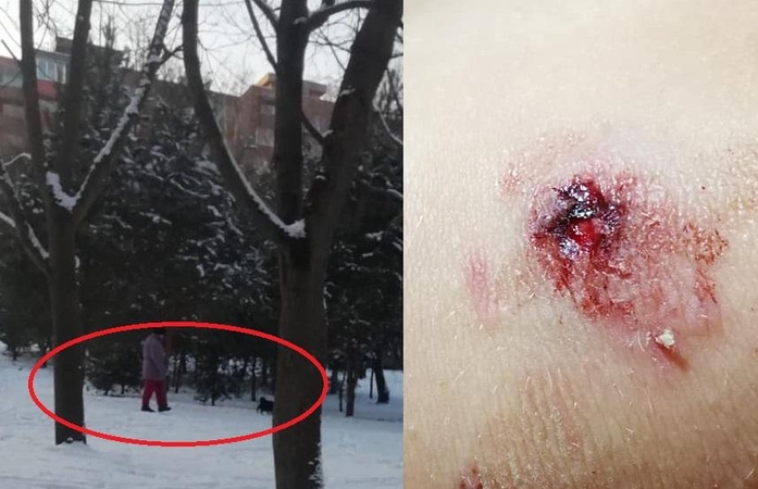 Mama šokiruota: vaikui įkando šuo, o šeimininkė net nesustojo 