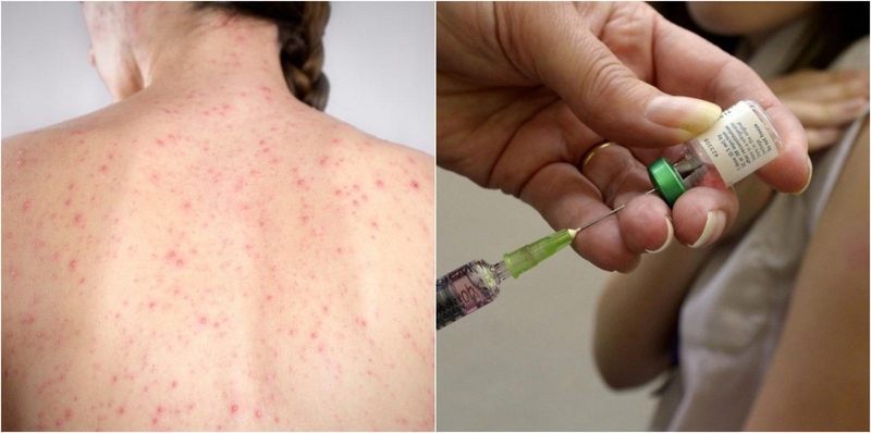 2019 metais Ukrainoje tymai diagnozuoti beveik 57 tūkst. žmonių