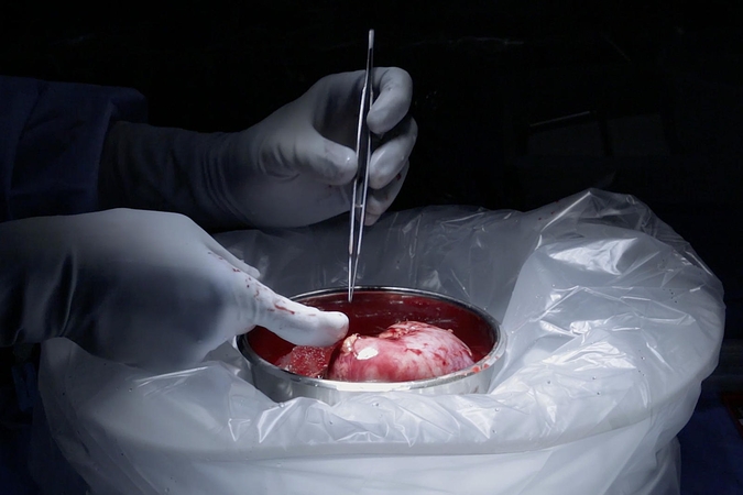 Bulgarijoje susektas nelegalios inkstų transplantacijos tinklas