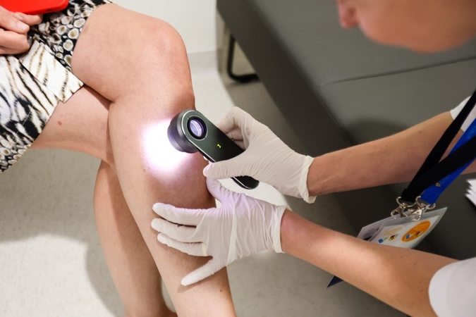 Penktadienį – nemokami melanomos tyrimai didžiuosiuose Lietuvos miestuose