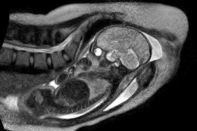 Panaudojant MRI skenavimą nufilmuotas trimatis gimstančio kūdikio vaizdas