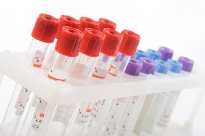 Hemofilija sergančiam vyrui diagnozuota kempinligė
