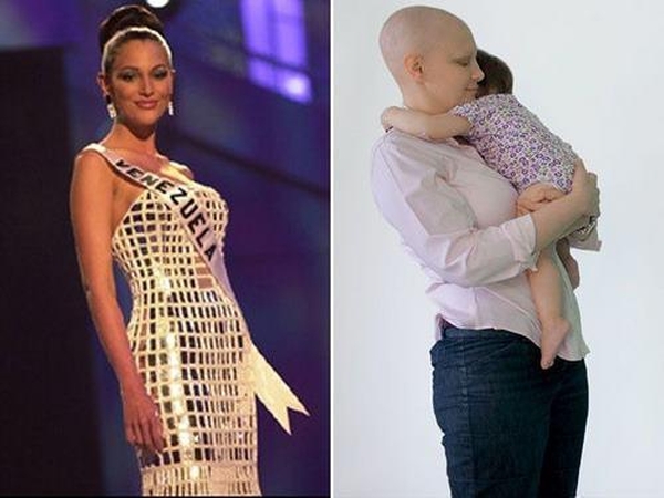 Sulaukusi 28 metų, nuo krūties vėžio mirė Mis Venesuela